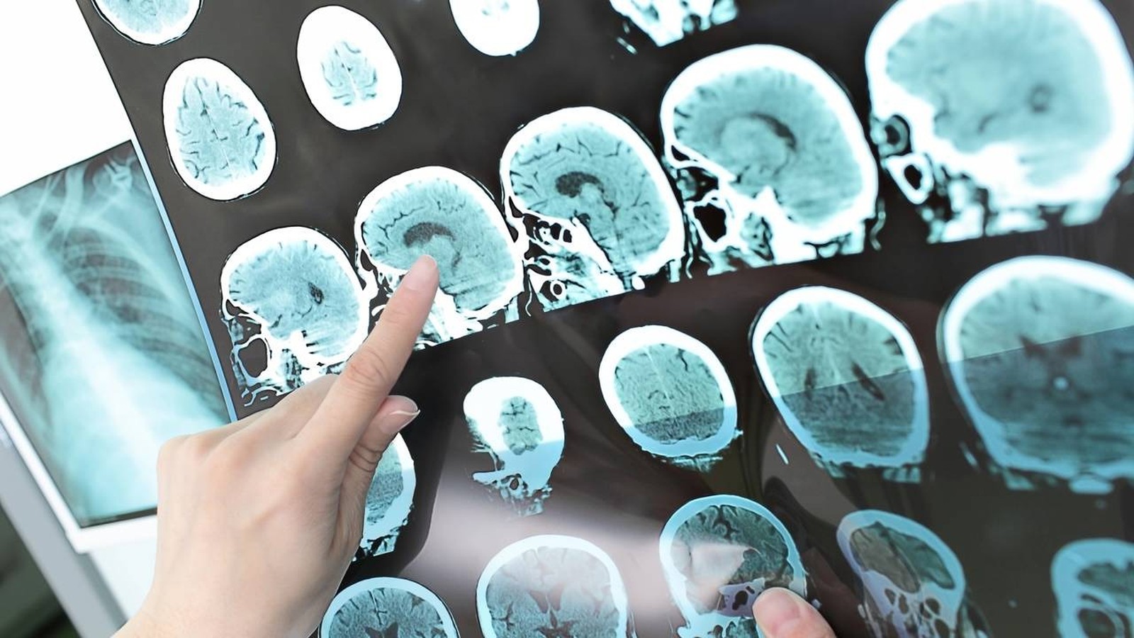Mão apontando para exames de tomografia computadorizada do cérebro em um painel médico