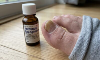Unha do pé amarelada e espessa ao lado de medicamento antifúngico, com crescimento saudável visível na base.