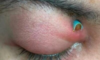 Close-up de pálpebra inflamada e avermelhada com ponta de canudo azul parcialmente visível