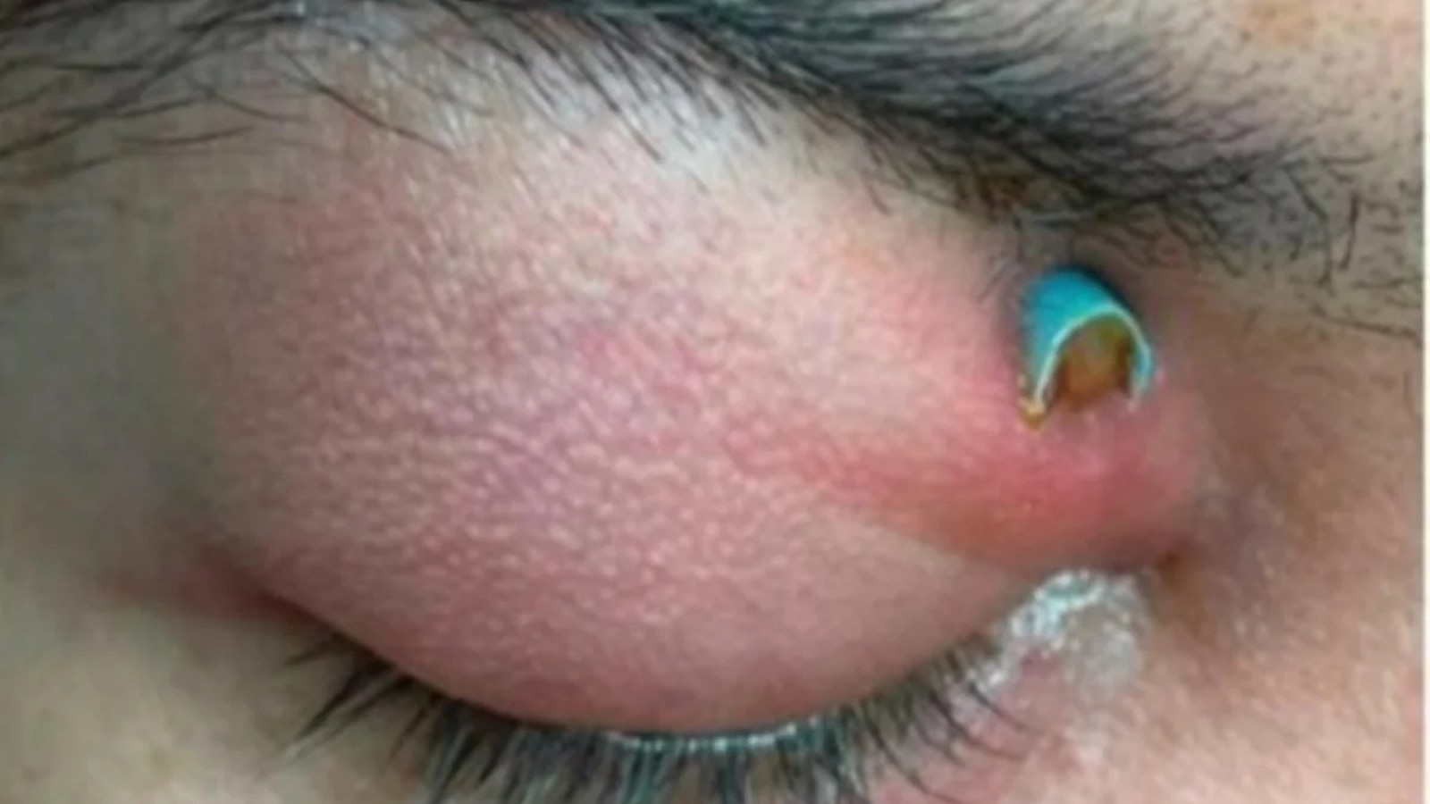 Close-up de pálpebra inflamada e avermelhada com ponta de canudo azul parcialmente visível