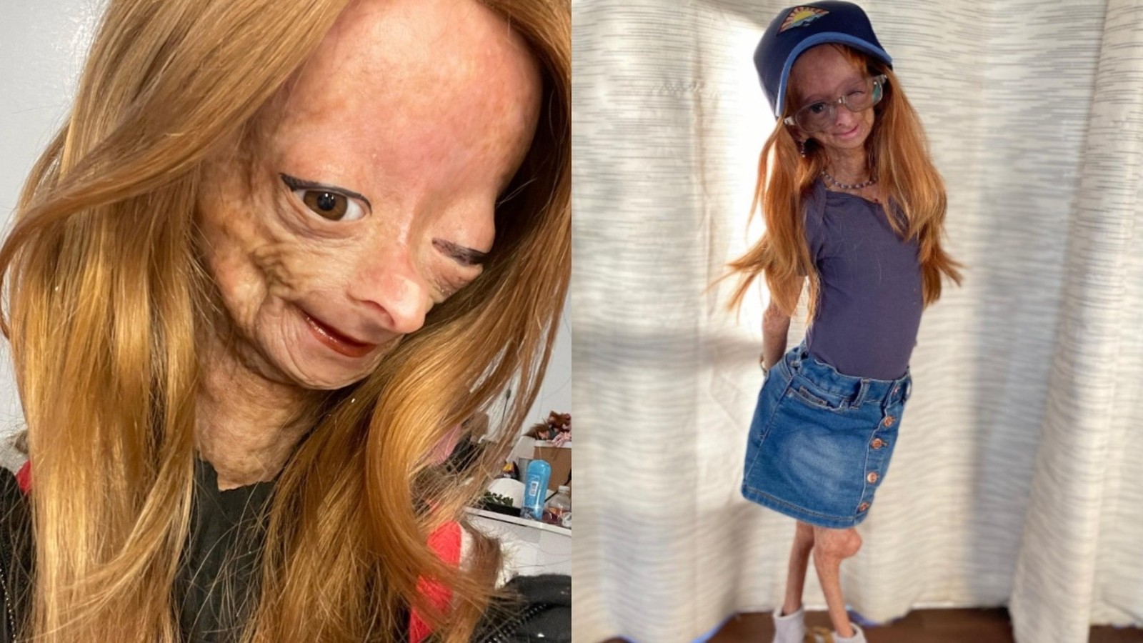Jovem com progéria em close-up facial e foto de corpo inteiro com boné e saia jeans