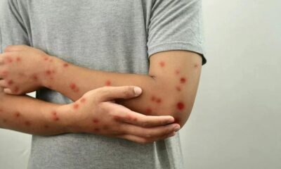 Braços e mãos de uma pessoa com diversas erupções cutâneas avermelhadas e elevadas na pele