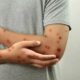 Braços e mãos de uma pessoa com diversas erupções cutâneas avermelhadas e elevadas na pele