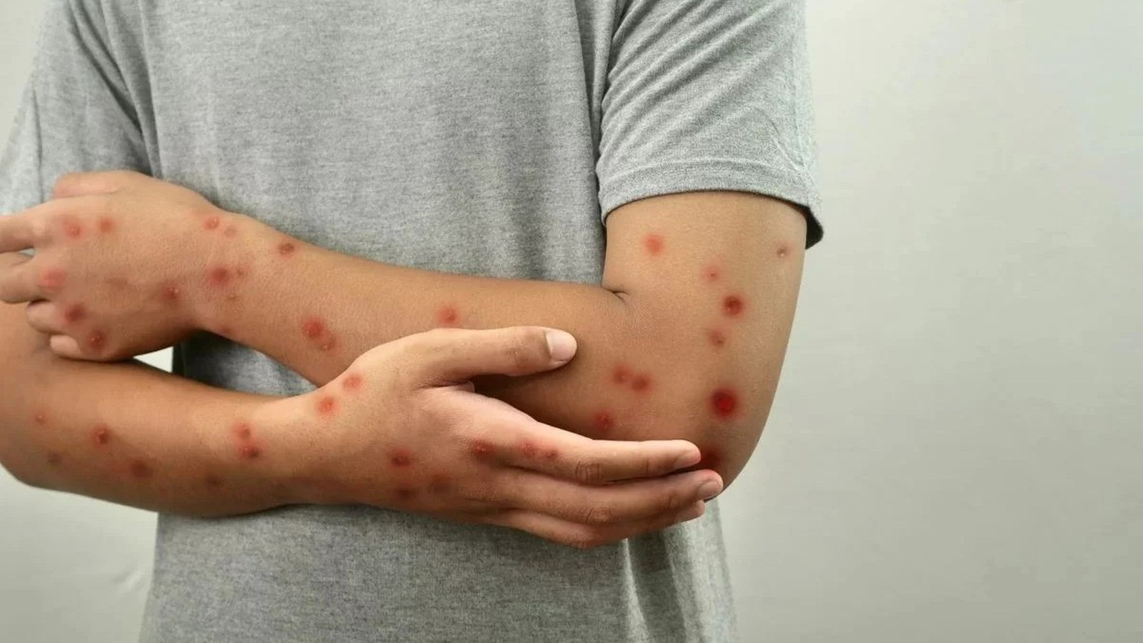 Braços e mãos de uma pessoa com diversas erupções cutâneas avermelhadas e elevadas na pele