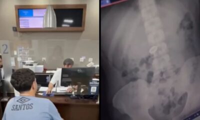 Homem em recepção de hospital e raio-X mostrando aliança de namoro no abdômen