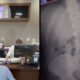 Homem em recepção de hospital e raio-X mostrando aliança de namoro no abdômen