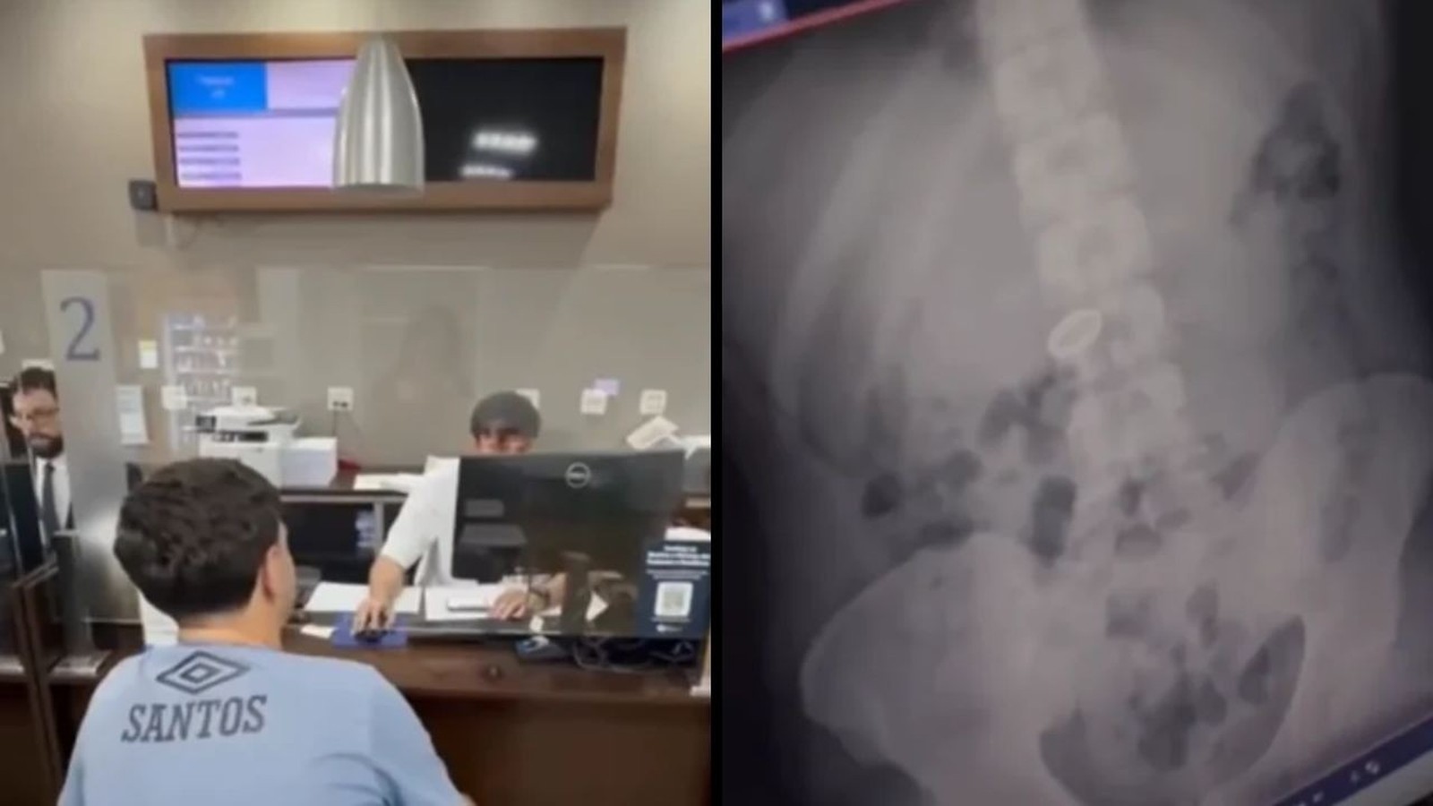 Homem em recepção de hospital e raio-X mostrando aliança de namoro no abdômen
