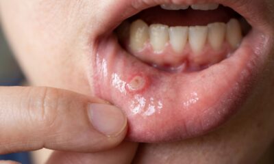 Nem sal nem bicarbonato diretamente na afta: dentistas explicam quais cuidados caseiros podem ajudar a aliviar a dor