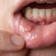 Nem sal nem bicarbonato diretamente na afta: dentistas explicam quais cuidados caseiros podem ajudar a aliviar a dor