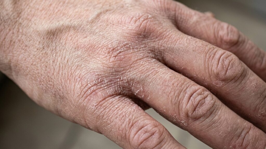Dermatologistas explicam: “Se suas mãos ficam ressecadas e com pequenas fissuras, cremes com ureia podem ajudar a reter água na pele e favorecer a recuperação da barreira cutânea”