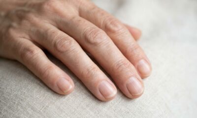 Dermatologistas explicam: se as unhas apresentam pequenas linhas verticais depois dos 60, pode não ser necessariamente falta de vitaminas, mas uma mudança natural com a idade, embora alterações repentinas mereçam avaliação