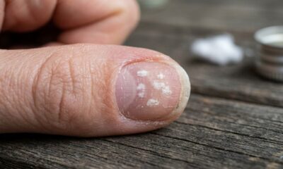 Nem sempre é micose: especialistas explicam por que algumas unhas ficam com aspecto branco e “empoeirado” depois de semanas cobertas por esmalte