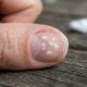 Nem sempre é micose: especialistas explicam por que algumas unhas ficam com aspecto branco e “empoeirado” depois de semanas cobertas por esmalte