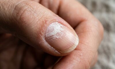 Especialistas em unhas explicam: se elas ficam esbranquiçadas e ásperas depois de retirar o esmalte, pode não ser micose, mas ressecamento da superfície, e “uma pausa na esmaltação pode ajudar”