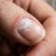 Especialistas em unhas explicam: se elas ficam esbranquiçadas e ásperas depois de retirar o esmalte, pode não ser micose, mas ressecamento da superfície, e “uma pausa na esmaltação pode ajudar”
