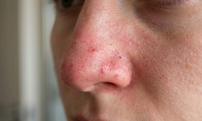 Dermatologistas afirmam: “Quem tenta remover cravos apertando o rosto pode acabar irritando a pele, enquanto limpeza adequada e ativos específicos podem ajudar de forma mais segura”