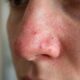 Dermatologistas afirmam: “Quem tenta remover cravos apertando o rosto pode acabar irritando a pele, enquanto limpeza adequada e ativos específicos podem ajudar de forma mais segura”