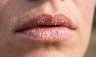 Dermatologistas explicam: “Os lábios também podem sofrer queimaduras solares e ressecamento, mas muita gente esquece de proteger essa região do rosto com um hidratante labial com FPS”