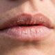 Dermatologistas explicam: “Os lábios também podem sofrer queimaduras solares e ressecamento, mas muita gente esquece de proteger essa região do rosto com um hidratante labial com FPS”
