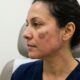 Dermatologistas alertam: tentar clarear uma mancha que está irritada pode acabar deixando a região ainda mais escura, e “arder não significa que o produto está funcionando”