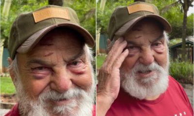 Lima Duarte com o rosto machucado depois de cair em casa