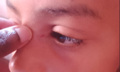 Criança é ferida por estilhaços no Lins