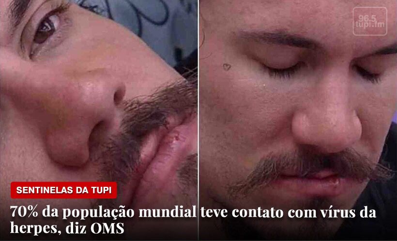Herpes doença Sentinelas da Tupi Especial